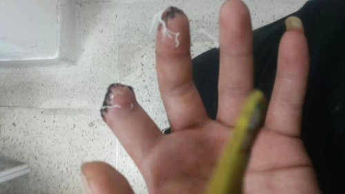 工伤中指远节骨折怎么赔偿的：手中指骨折工伤伤残等级及赔偿
