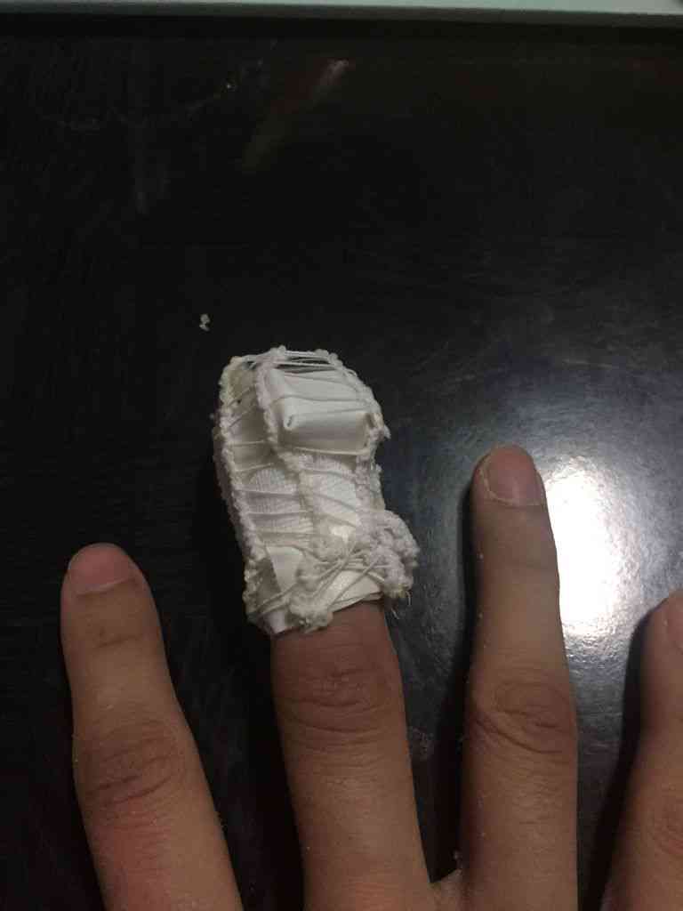 手中指远节指骨骨折伤残评定及十级伤残可能性分析